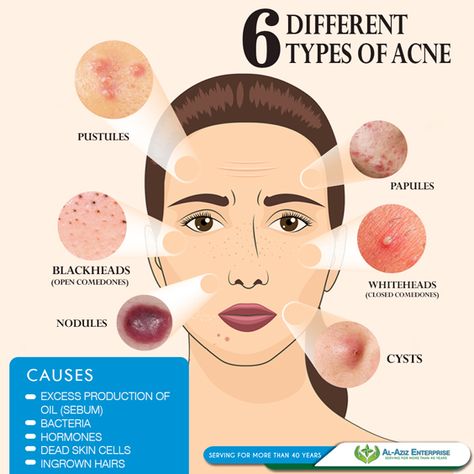 Acne is a skin condition that occurs when your hair follicles become plugged with oil and dead skin cells. It often causes whiteheads, blackheads or pimples, and usually appears on the face, forehead, chest, upper back and shoulders. Acne is most common among teenagers, though it affects people of all ages.  Acne signs and symptoms vary depending on the severity of your condition Forehead Pimples, Pimple Solution, Pimple Causes, Pimples On Forehead, Different Types Of Acne, Forehead Acne, Pregnancy Skincare, Clean Blackheads, Acne Help