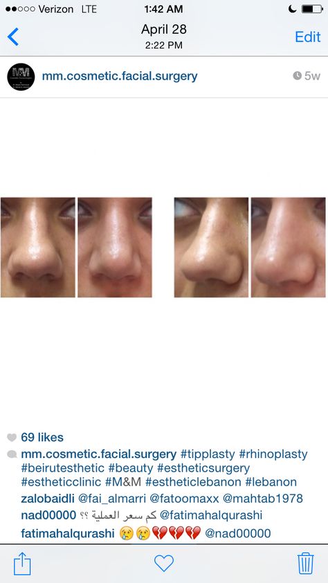 Tip plasty Tip Plasty, Refined Tip Rhinoplasty, Rhinoplasty Droopy Tip, Beirut, Surgery, Movie Posters