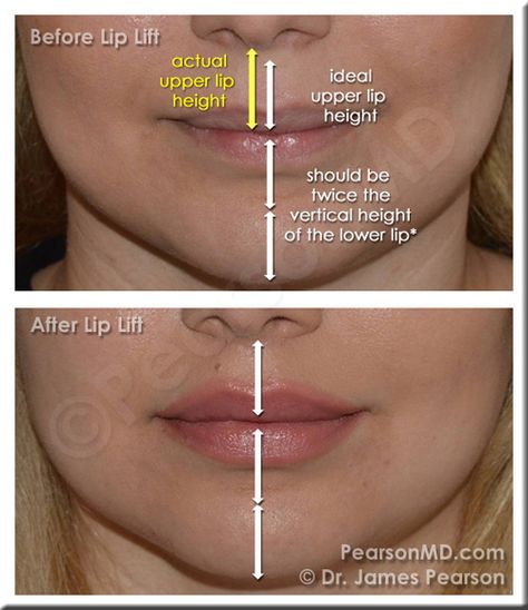 Lip Proportion - Upper Lip : Lower Lip The vertical height of the upper lip is ideally one half the height of the lower lip. Elongation of the cutaneous portion of the upper lip may lead to disproportion in this natural ratio, and may contribute to the appearance of a less aesthetically pleasing lip area. -  LIP LIFT IS MY DREAM PROCEDURE </3 Upper Lip Filler, Lip Plastic Surgery, Upper Lip Lift, Lip Surgery, Lip Lift, Nose Reshaping, Lips Inspiration, Upper Lip Hair, Botox Lips