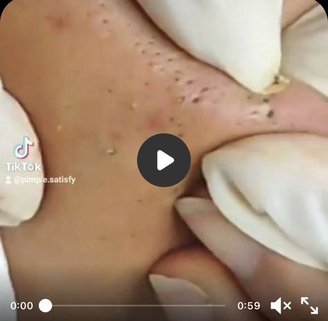 Blackheads removal satisfying video Satisfying Black Head Removal Video, Black Heads Removal Video, Pores Removal, Blackheads Removal Cream, Pimple Extraction, Oatmeal Face Mask, Blackhead Remover Diy, Remedies For Acne, Mild Acne