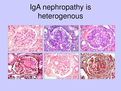 PPT - An international evidence-based classification of IgA nephropathy: the Oxford Classification PowerPoint Presentation - ID:6068846 Iga Nephropathy, Basement Membrane, Red Blood Cells, Blood Cells, Data Collection, Data Analysis, Powerpoint Presentation, Presentation