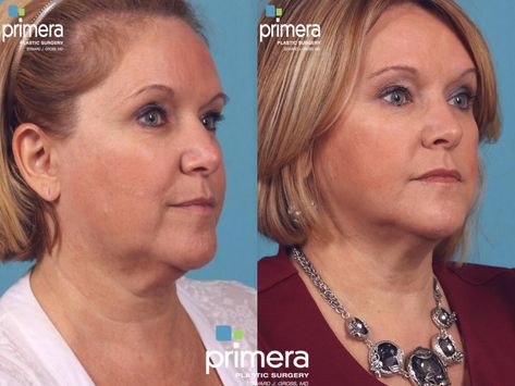 Will Ultherapy Get Rid of Jowls? See Before and After Photos – Primera Plastic Surgery Ultherapy Before And After, Get Rid Of Jowls, Loose Neck Skin, Hifu Face, Restylane Lyft, Skin Tightening Procedures, Forehead Lift, Facial Procedure, Rhinoplasty Nose Jobs