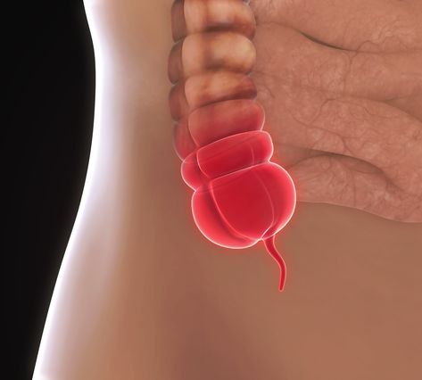 Appendicitis can strike at any age. Symptoms of an inflamed appendix can mimic other problems, and it’s always an emergency. Here’s what you need to know. Appendix Surgery, Laparoscopic Surgery, Bloated Belly, Cleveland Clinic, Stomach Ache, Family Medicine, Stomach Pain, Medical Help, Nutrition Advice