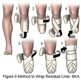 Below The Knee Amputation, Robotic Prosthetics, Orthotics And Prosthetics, Ambulatory Care, Surgical Technologist, Biomechanical Tattoo, Prosthetic Leg, Bionic Woman, Kinesiology Taping