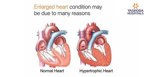 Enlarged Heart: Heart Enlargement Causes | Signs of Enlarged Heart Heart Foods, Heart Symptoms, Pericardial Effusion, Enlarged Heart, Throbbing Headache, Heart Diseases, Normal Heart, Tea Health, Congenital Heart