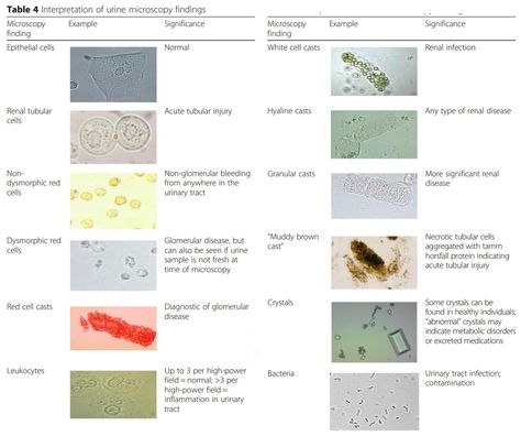 Atlas of Urine Microscopy Findings • Epithelial cells ... Urine Sediment Atlas, Urine Microscopic Examination, Urine Microscopy, Microscopic Cells, Medical Lab Technician, Laboratory Scientist, Clinical Chemistry, Medical Laboratory Scientist, Medical Lab