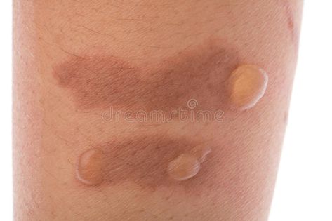 Burn blisters on the skin. Second degree scald burn blister on the skin , #spon, #skin, #blisters, #Burn, #degree, #blister #ad Second Degree Burn, Degree Burns, Creative Icon, Home Remedies, Paw Print Tattoo, Icon Design, Branding Design, Stock Photos, Skin