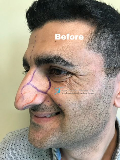 Celebrity nose job: before and after Best Nose Jobs, Nose Job Before And After Rhinoplasty, Before And After Nose Job, Nose Jobs Before And After, Celebrity Nose Jobs, Nose Jobs, Male Nose Job, Male Rhinoplasty, Jennifer Aniston Nose Job