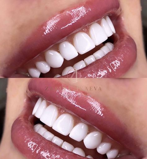 Whiten Your Teeth At Home, Loose Teeth, Teeth Aesthetic, I Healed, Pretty Teeth, Veneers Teeth, Beautiful Teeth, Loose Tooth, Whiten Your Teeth