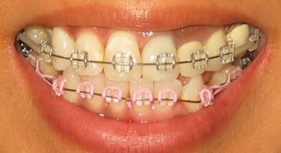 Image Ceramic Braces With Colored Bands, Ceramic Braces Color Bands, Clear Braces With Color Bands, Pink Braces, Lingual Braces, Ceramic Braces, Jasmine Tattoo, Types Of Braces, Kids Braces