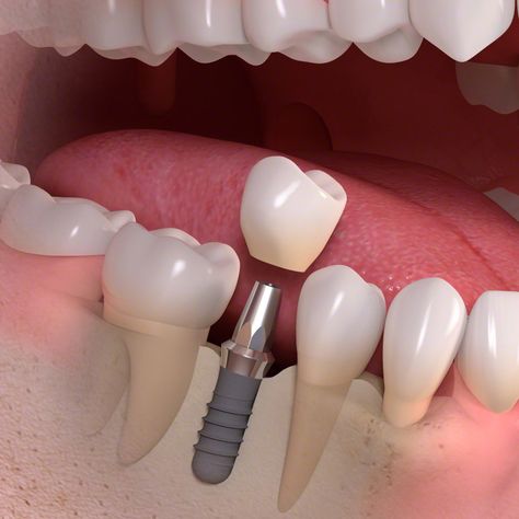 Medicover Dental Clinic - All Ceramic Crown Cost Dental Implant Procedure, Dental Posters, Best Dental Implants, Dental Implants Cost, Tooth Replacement, Implant Dentistry, Teeth Implants, Dental Bridge, Dental Crowns