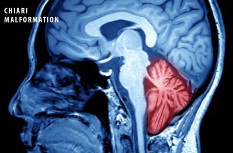 Chiari Malformations - Nashville Neurosurgery Associates Spinal Fluid, Spinal Surgery, Chiari Malformation, The Skull, Medical Advice, The Brain, Headache, Beautiful Birds, Nashville