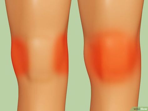 How to Heal a Meniscus Tear (with Pictures) Meniscal Tear, Yoga For Sciatica, Ways To Heal, Lymph Fluid, Physical Therapy Exercises, Thigh Muscles, Health And Fitness Articles, Muscle Spasms, Fitness Articles