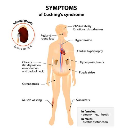 Cushing Syndrome, Cushing’s Syndrome, Cushings Syndrome, Muscle Weakness, Adrenal Glands, Endocrine System, Hormone Health, Coping Strategies, Signs And Symptoms