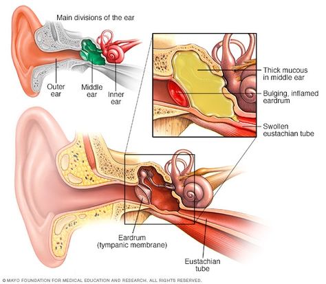 Swimmers Ear, Woman Health, Constant Headaches, Turmeric Vitamins, Middle Ear, Ear Infections, Ear Health, Chest Congestion, Ear Wax Removal