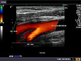 Carotid Artery Ultrasound, Carotid Ultrasound, External Carotid Artery, Sonography Student, Color Flow, Carotid Artery, Eyes On The Prize, Dream Career, Fade Out