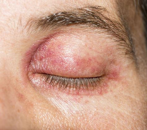 Learn about eyelid dermatitis, including types, causes, symptoms, and prevention, and how to get rid of these itchy, dry eyelid rashes. Itchy Eyelids, Dry Eyelids, Skin Cream Anti Aging, Itchy Eyes, Skin Specialist, Skin Treatments, Home Remedies, Allergies, Medicine