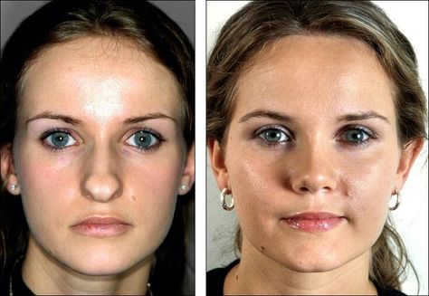 Bulbous Tip Rhinoplasty Before After, Rhinoplasty Bulbous Tip, Bulbous Tip Rhinoplasty, Bulbous Nose Rhinoplasty Before After, Bulbous Nose Rhinoplasty, Tip Rhinoplasty, Facial Harmony, Nose Surgery Rhinoplasty, Lipo Before And After