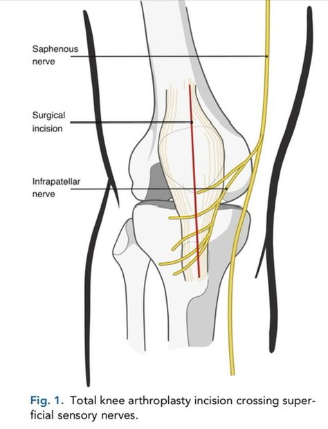 What Wear After Knee Replacement Surgery Siatic Nerve, After Knee Replacement Surgery, Peripheral Nerve, Knee Replacement Surgery, Ten Unit, Muscle Weakness, Orthopedic Surgery, Knee Surgery, Knee Replacement