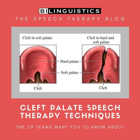 Cleft Palate Speech Therapy, Speech Therapy Toddler, Cleft Lip And Palate, Cleft Palate, Soft Palate, Therapy Techniques, Cleft Lip, Slp Resources, Speech Path