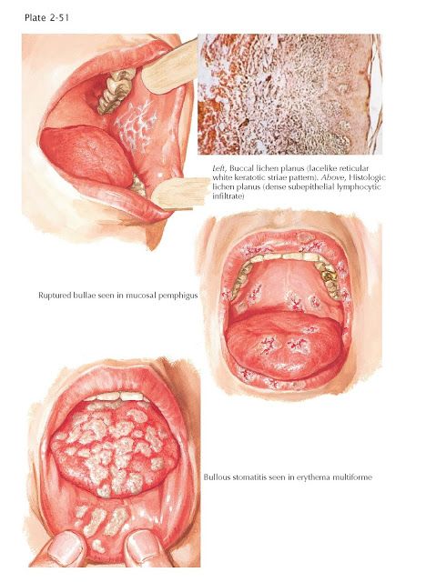 Langerhans Cell Histiocytosis, Langerhans Cell, Steven Johnson Syndrome, Tuberous Sclerosis, Oral Pathology, Dental World, Basal Cell, Skin Disorders, Medical Knowledge