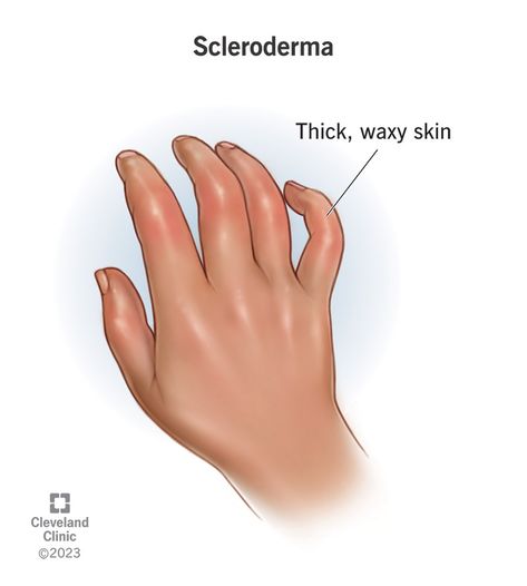 What Is Scleroderma? Scleroderma Symptoms, Pericardial Effusion, Gastrointestinal Disease, Salivary Gland, Messages Of Hope, Cleveland Clinic, Autoimmune Disorder, For Healthy Skin, Chronic Condition