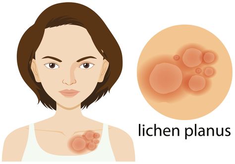 Lichen planus
skin health
dermatologist
skin care Lichen Planus, Skin Condition, Skin Disorders, Skin Diseases, Best Moisturizer, Medical Research, Light Therapy, Dermatology, Skin Conditions