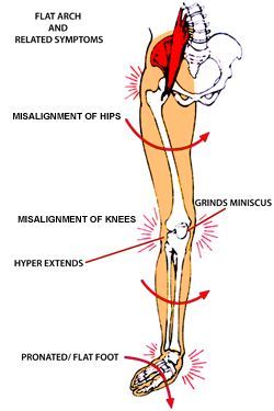 Weak Arches: What Causes Them and How to Fix It | Physio Logic My Knee Hurts, Foot Exercises, Craniosacral Therapy, Muscle Imbalance, Hip Flexor, Foot Health, Shoulder Pain, Foot Pain, Sciatica