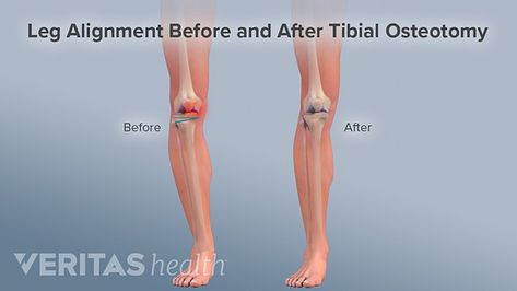 A knee osteotomy can change bone alignment so that the mechanical axis passes though the center of the knee and weight is more evenly distributed. This can help avoid further joint degeneration. Bow Legged Correction, Knock Knees, Homemade Body Care, Bow Legged, Knee Surgery, Health Trends, Feeling Happy, Workout Videos, Surgery