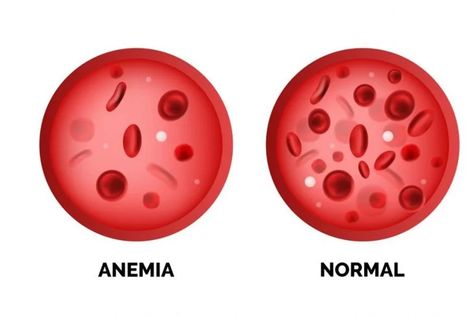 Causes of High and Low Hemoglobin Levels - Facty Health Medical Assistant Student, Hemoglobin Levels, Penyakit Jantung, Cells And Tissues, Vitamin Deficiency, Iron Rich Foods, Pulmonary Disease, Nursing Tips, Red Blood Cells