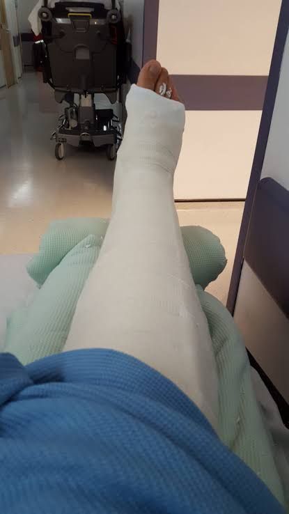 Leg Bandage Snapchat, Broke Leg Snapchat, Ankle Cast, Burned Hand Pic, Aesthetic Person, Medical Boot, Long Leg Cast, Fake Ft Call, Broken Foot