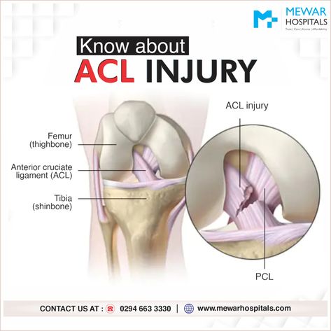 An ACL injury is a sprain of the anterior cruciate ligament (ACL) one of the strong bands of tissue that help connect your thigh bone to your shinbone. ACL injuries most commonly occur during sports that involve sudden stops or changes in direction, jumping and landing such as basketball, and football. For more information call 0294 663 3330. #mewarhspital #acl #aclinjury #aclsurgery #tibia #femurfracture #aclrecovery #AnteriorCruciateLigament #facebook #injury #healthcare #pain Knee Injury Pics, Acl Injury, Acl Recovery, Acl Surgery, Anterior Cruciate Ligament, Acl Tear, Cruciate Ligament, Princess Pictures, Knee Pain