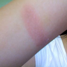 How To Treat Burns Skin, Nursing Burns, Second Degree Burn Healing, 2nd Degree Burns, Degree Burns, Severe Burns, Sun Damaged Skin, Damaged Skin, Home Remedies