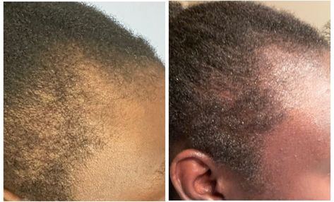 Breakage Hair, Before And After Hair, Receding Hair Styles, Fast Hair Growth, Growing Hair, Dry Brittle Hair, Fast Hair, Strengthen Hair, Hair Dry