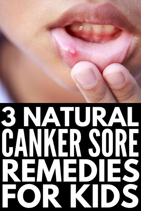 Natural Canker Sore Remedy, Canker Sore Remedies, Sore In Mouth Remedies, Gum Sores, Ulcer Remedies Mouth, Canker Sore Remedy, Remedies For Dry Mouth, Sore Throat Remedies, Canker Sore