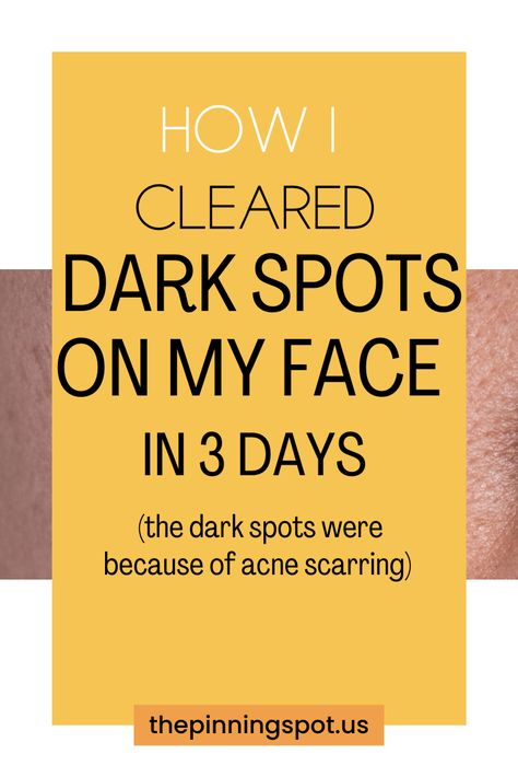 Do you know what it really take to lighten dark spots on your face? Find out in this comprehensive guide the best products & skin tips to effectively clear hyperpigmentation & acne marks. You'll find the secrets to fading acne marks naturally that cause dark spots on your face so as to achieve a flawless complexion in just three days. It's a proven 3-day routine to diminish dark spots on your face naturally, packed with skin tips and product recommendations to achieve a flawless complexion Dark Spot Corrector Diy, Face Dark Spots Remedies, How To Get Rid Of Age Spots On Face, Fading Dark Spots On Face, Remedies For Dark Spots On Face, How To Remove Age Spots On Face, How To Fade Dark Spots On Face, Dark Marks On Face How To Get Rid Of, Acne Dark Spots Remedies