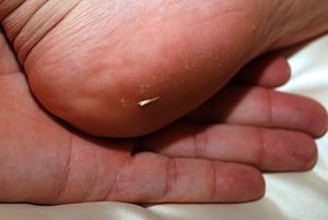 Wish i had known this before traumatizing my boy...how to remove a splinter without pain using baking soda. every mom needs to know this one. Remove A Splinter, Splinter Removal, Mom Needs, E Mc2, Homemade Remedies, Back To Nature, Health And Beauty Tips, Household Tips, Household Hacks