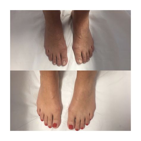 This is my first before and after from my pedicure assessment Nails Aftercare Advice, Spa Pedicure Treatments, Manicure After Acrylic Removal, Pedicure Procedure, Love Nails, Manicure And Pedicure, Nail Tech, Assessment, Manicure