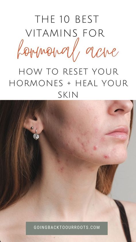 Top Supplements to Naturally Treat Hormonal Cystic Acne at Home! Hormonal Imbalance Acne, Hormonal Cystic Acne, Acne Women, Acne Supplements, Hormonal Acne Remedies, Back Acne Remedies, Acne Diet, Natural Acne Remedies, Acne Causes