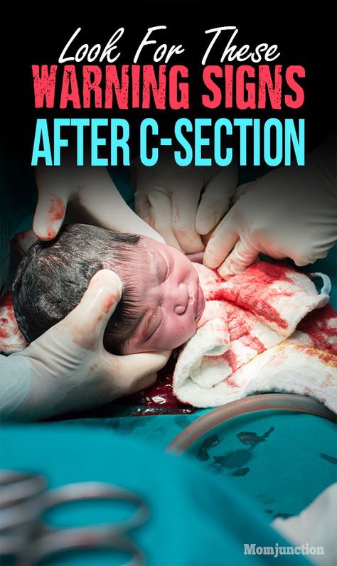 C Section Recovery, Post Pregnancy Workout, Pregnant Baby, Mom Junction, Pregnancy Health, Postpartum Recovery, C Section, Pregnancy Care, First Pregnancy