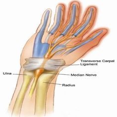 5 Powerful Herbal Remedies For Carpal Tunnel - How To Treat Carpal Tunnel Syndrome Naturally | Natural Home Remedies Carpel Tunnel Syndrome, Carpel Tunnel, Median Nerve, Senior Health, Carpal Tunnel, Alternative Health, Health Info, Health And Beauty Tips, Home Health