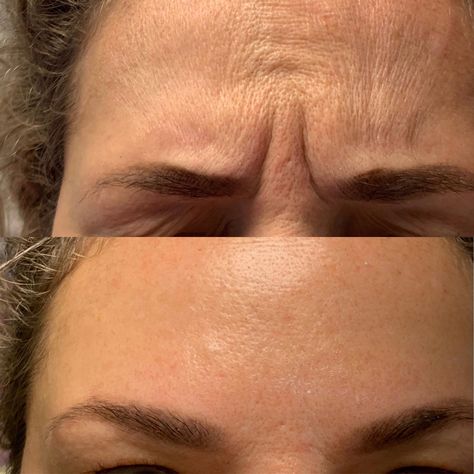 Botox Face Before And After, Wrinkles Before And After, Face Botox Before And After, Botox Frown Lines Before After, Forehead Botox Before And After, Before And After Botox Pictures, Fillers Before And After, Botox Before After, Botox Aesthetic