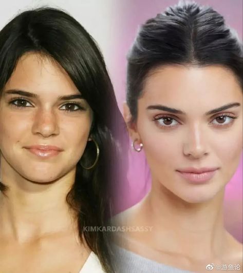 Upper Blephoraplasty, Kendall Jenner Icons, Rhinoplasty Nose Jobs, Eyeliner Techniques, Fox Eyes, Facial Aesthetics, Celebrity Plastic Surgery, Eye Surgery, Glowy Makeup