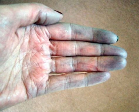 What Is Raynaud's Disease? - Health - NAILS Magazine Reynauds Syndrome, Professional Nail Designs, Nail Design Kit, Reflexology Massage, Nerve Damage, Nail Services, Nail Fungus, Nails Magazine, Disease