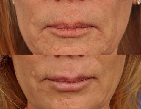 Microneedling Before and After Pictures | W Skin Studio Before And After Microneedling, Dr Pen Microneedling Before And After, Rf Microneedling Before And After, Micro Needling Before And After, Microneedling Before And After, Microneedling With Prp, Botox Before And After, Skin Studio, Micro Needling