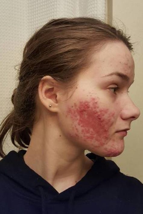 Girl With Acne, Covering Acne, Acne Overnight, Greasy Skin, Natural Acne Remedies, Natural Acne, Severe Acne, Types Of Acne, Popsugar Beauty