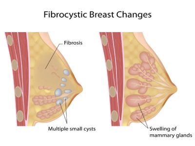 Stuffy Nose Remedy, Low Estrogen Symptoms, Too Much Estrogen, Mammary Gland, Estrogen Dominance, Stuffy Nose, Flax Seeds, Breast Health, Homeopathic Medicine