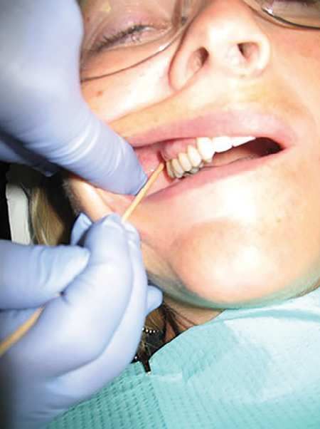 Registered Dental Hygienist, Molar Tooth, Dental Hygienist, Dental Hygiene, Success Rate, Calculus, Nerve