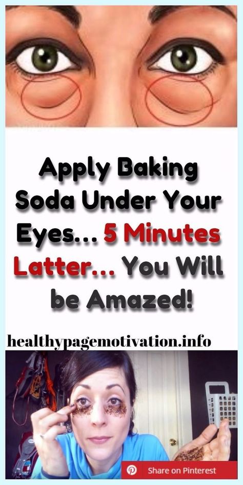 Apply Baking Soda Under Your Eyes…5 Minutes Latter…You Will be Amazed! Baking Soda Face, Baking Soda Benefits, Wrinkle Remedies, Skin Care Wrinkles, Remove Dark Circles, Baking Soda Uses, Baking Soda Shampoo, Dark Circles Under Eyes, Under Eye Bags