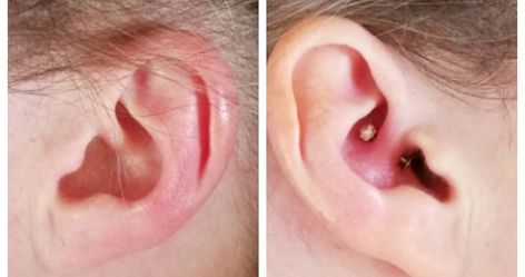 Daith Piercings for Migraines - FAQs What to do if your daith piercing gets infected... Piercings For Migraines, Daith Piercing Migraine, Migraine Piercing, Daith Piercings, Chronic Migraines, Migraine Headaches, Daith Piercing, Alternative Therapies, Quality Of Life